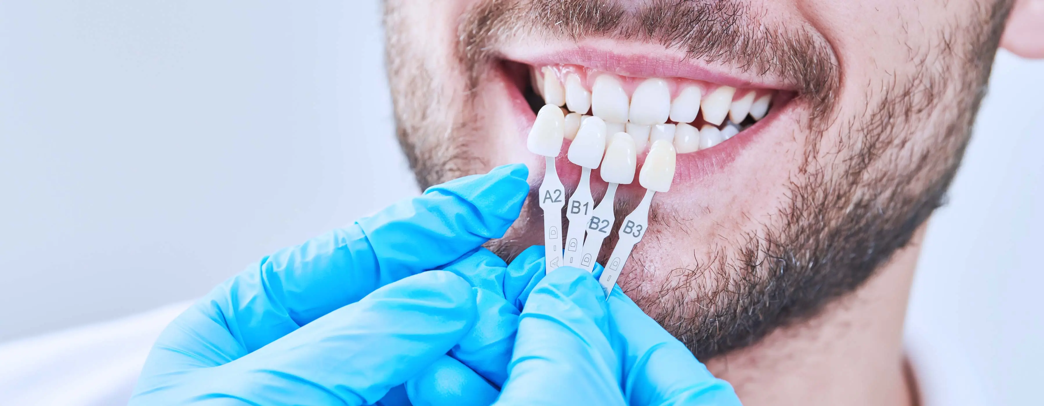 Foto em close das mãos de um cirurgião-dentista aplicando adesivos estéticos em paciente.