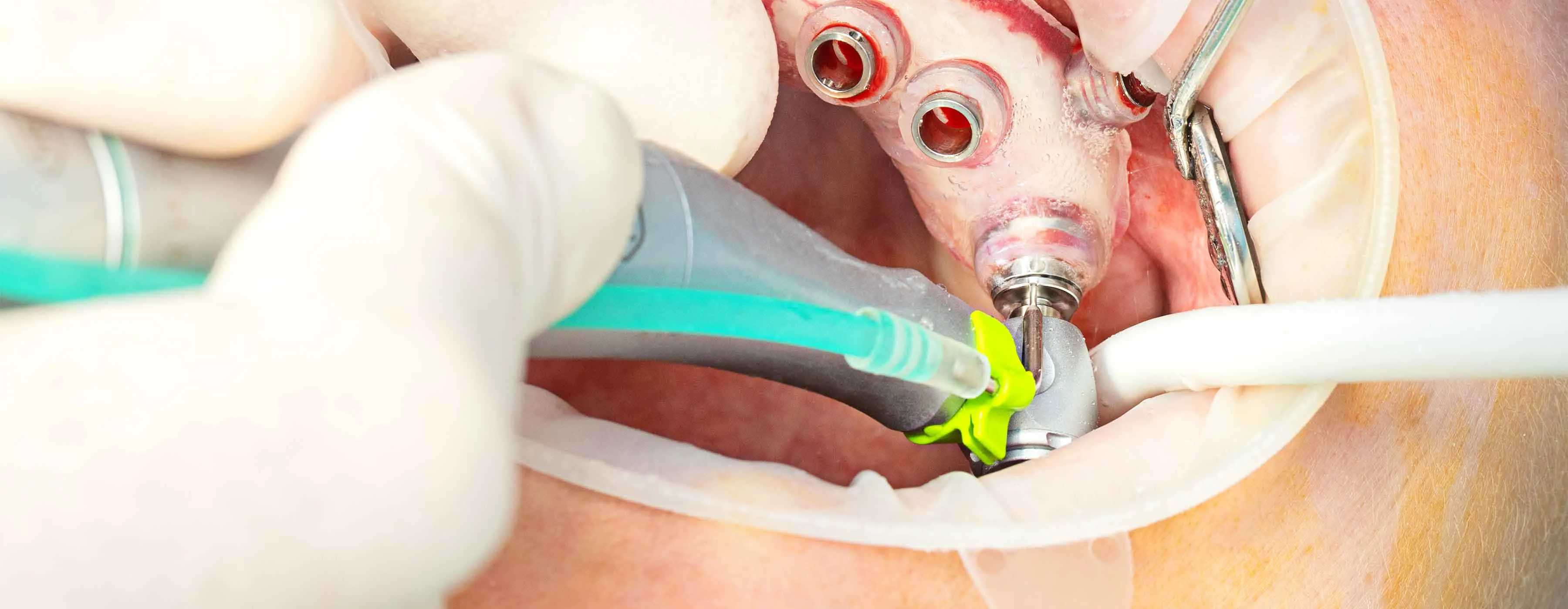 Processo de implantodontia em boca de paciente.