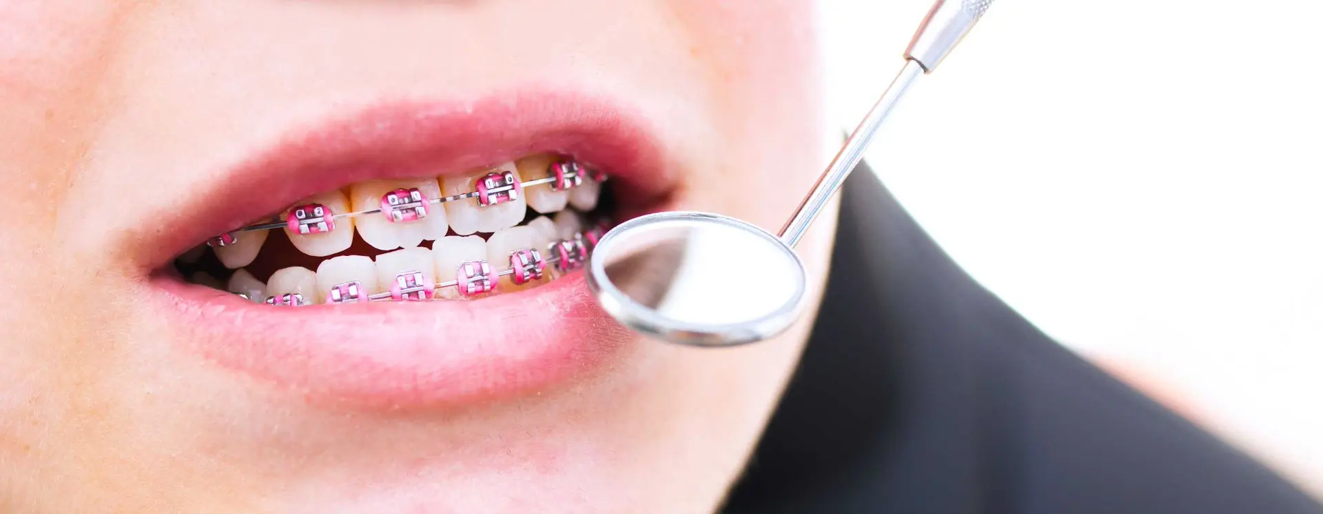Foto de boca em close com mini-espelho redondo do dentista próximo a boca entreaberta da paciente, que tem aparelhos ortodoônticos cor de rosa nos dentes.