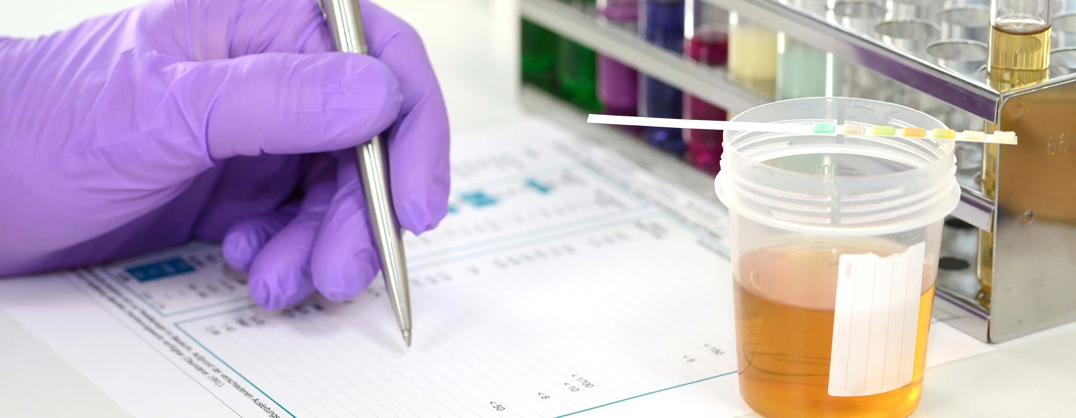 Foto de mão usando luvas roxas de laboratório escrevendo em papel ao lado de coletor de exame de urina com papel de teste