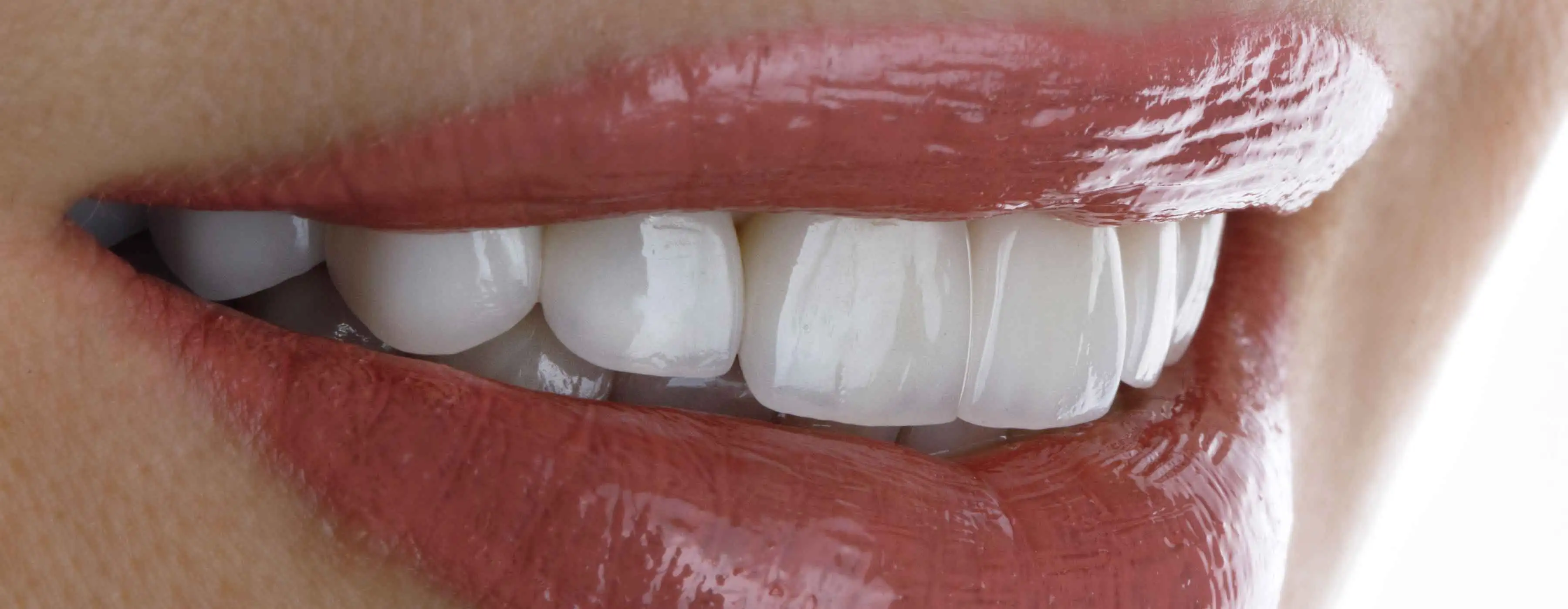 Boca com dentes brancos e alinhados.